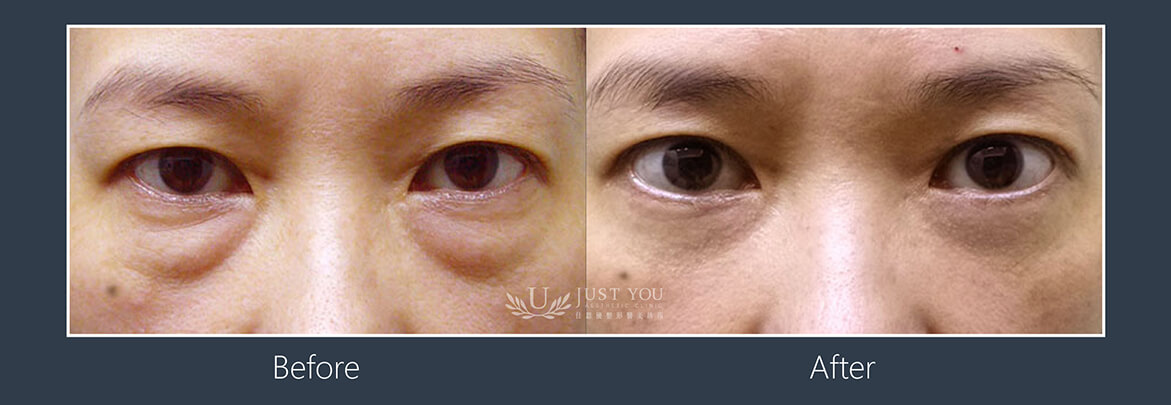 五合一隱痕眼袋－眼袋手術前後比較