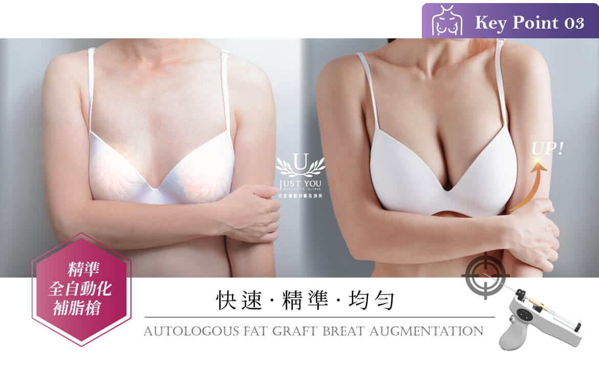 自體脂肪隆乳MAFT補脂槍治療前後