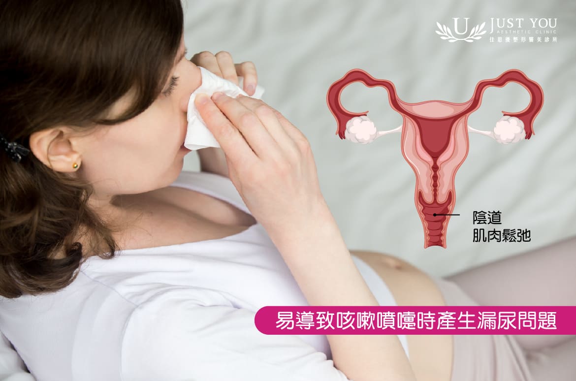 阴道松弛易导致咳嗽时产生漏尿问题
