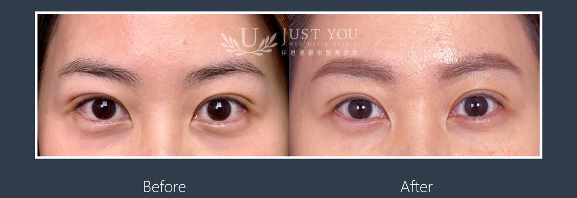 凤凰电波眼周拉提-实际案例