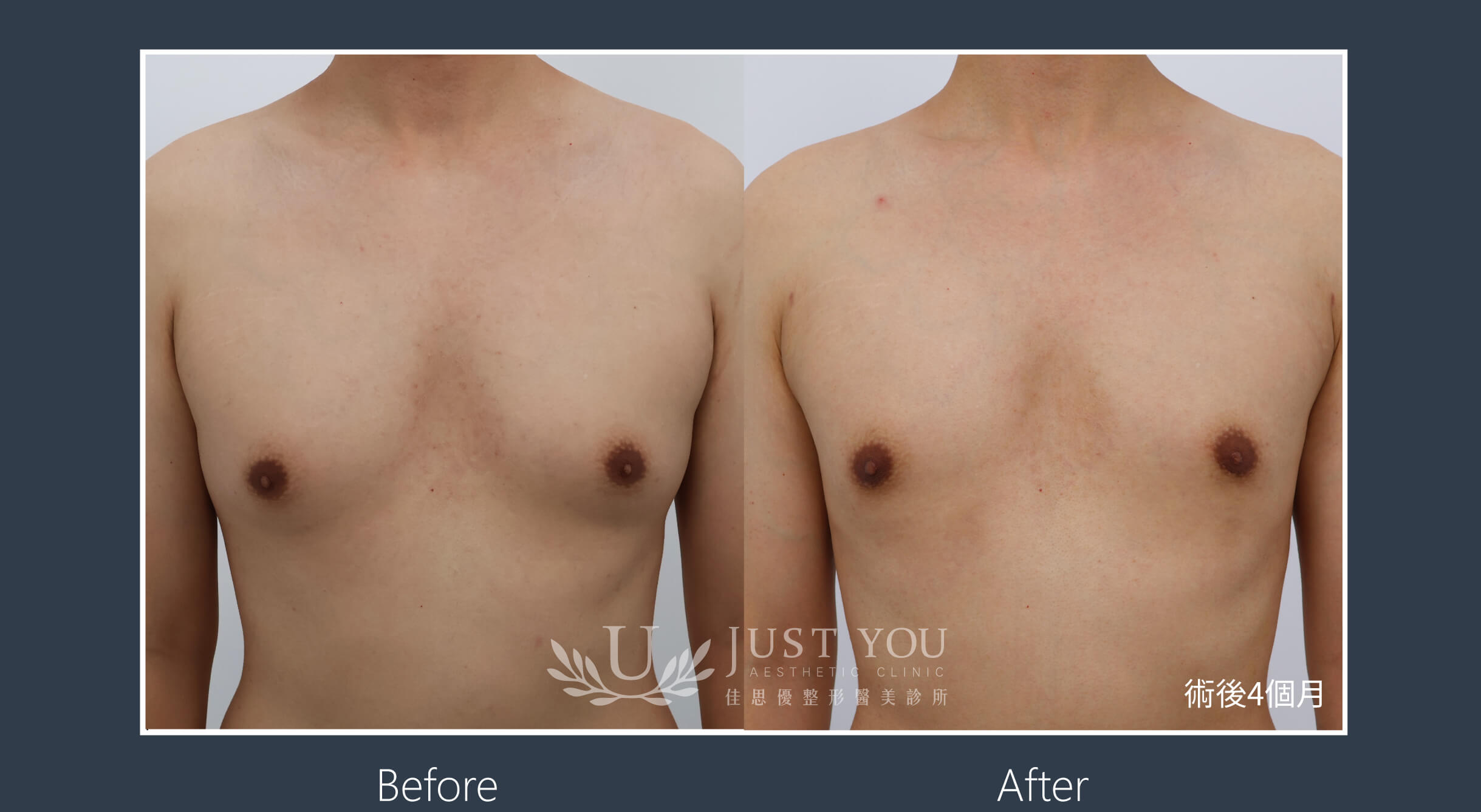 Gynecomastia男性女乳症實際案例-11