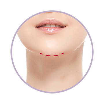天鵝頸美型術步驟一：下巴下緣開一個大約3cm的隱痕切口