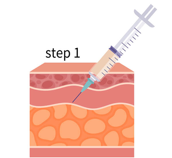 LSSA音浪脂雕原理與步驟１－讓麻醉液與皮下組織混合
