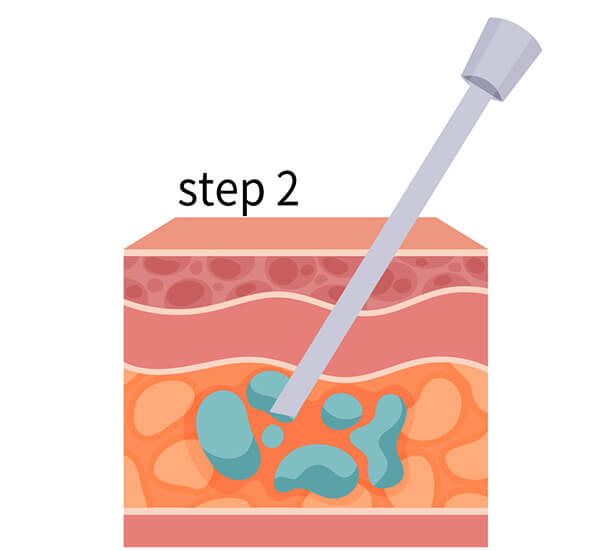 LSSA音浪脂雕原理與步驟２－液體滲透脂肪組織，使脂肪細胞吸水膨脹。
