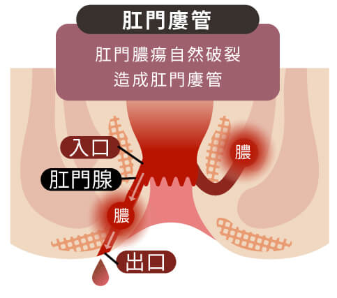 廔管是由於肛門周圍組織的感染形成的小通道