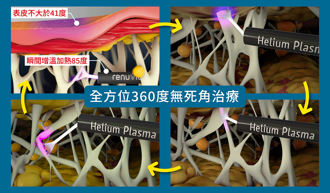 超能電漿二代溫和安全、高精準度，全方位360度無死角治療