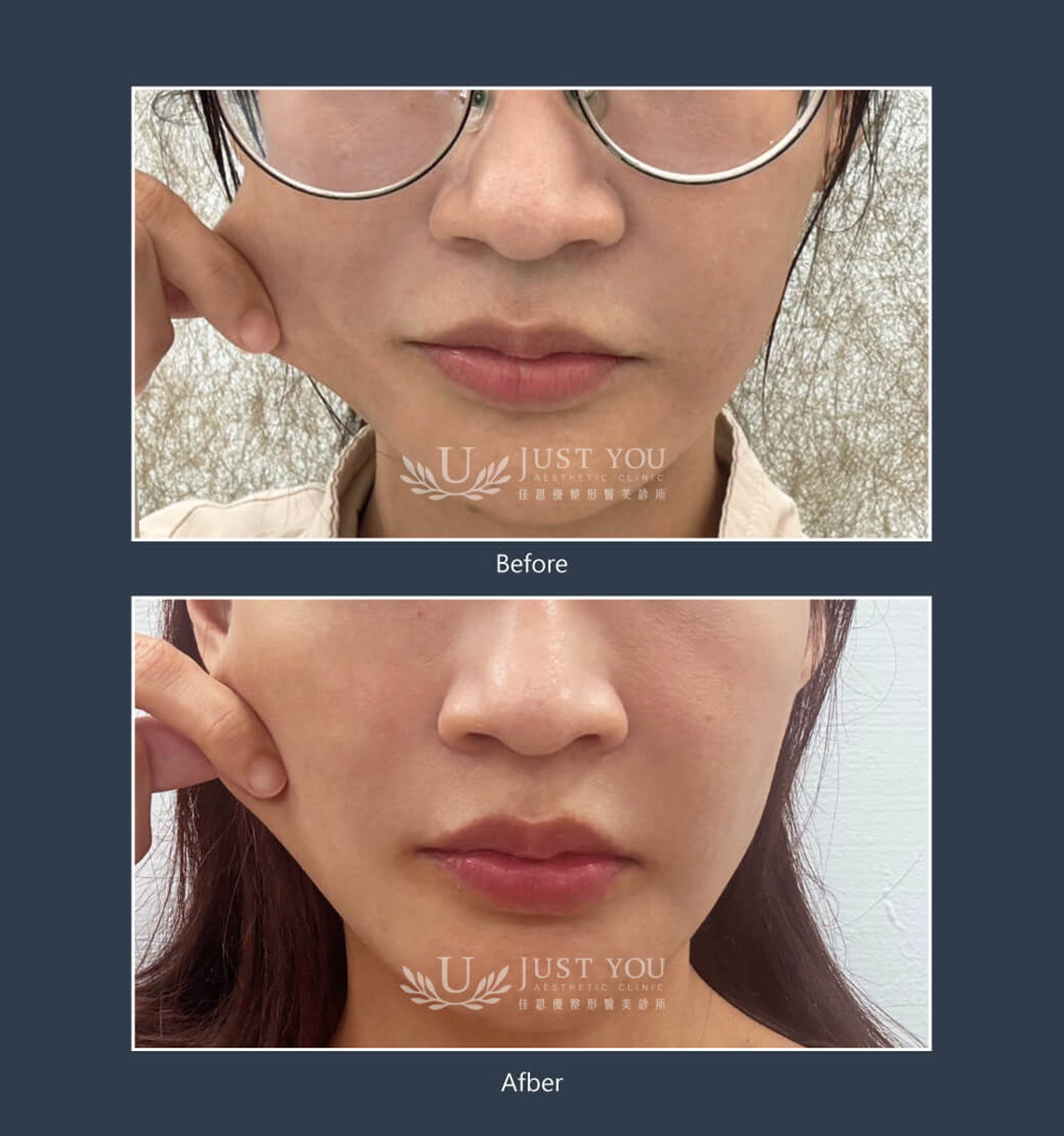 Profhilo 逆時針《實際案例》