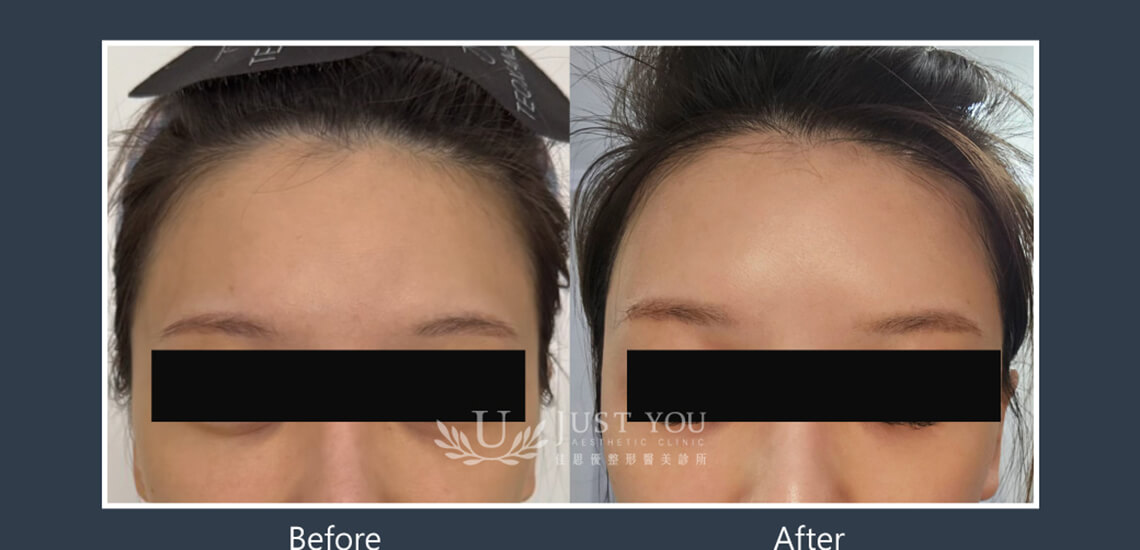 Profhilo 逆時針《實際案例》-額頭1-正面