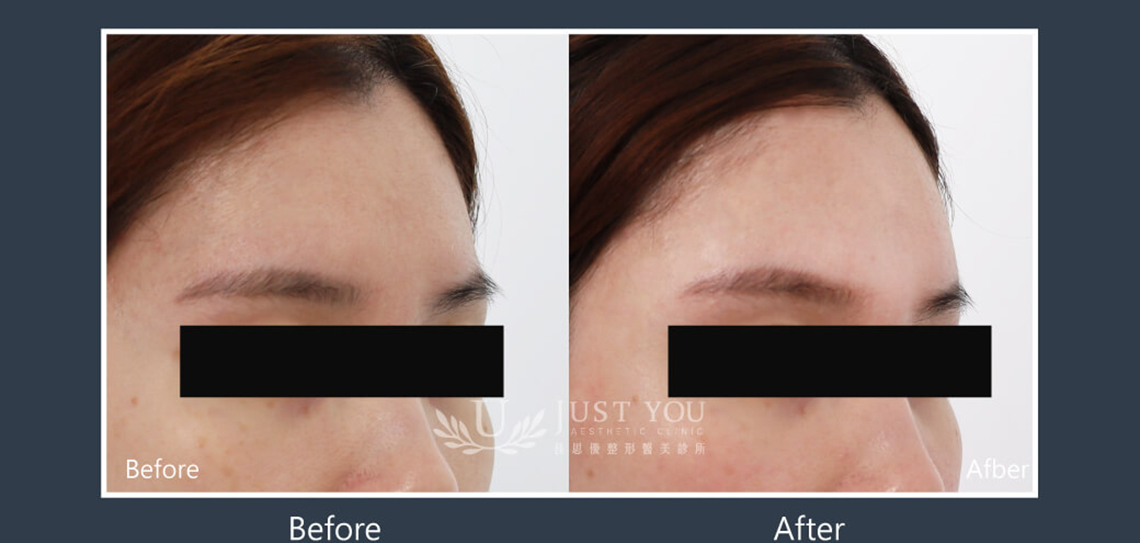 Profhilo 逆時針《實際案例》-額頭5-45度