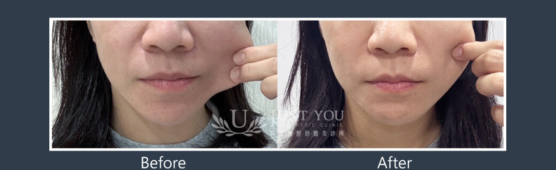 Profhilo 逆時針《實際案例》-臉頰鬆弛-案例2