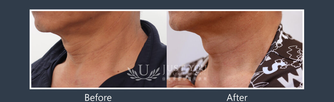 Profhilo 逆時針《實際案例》-脖紋治療-案例1