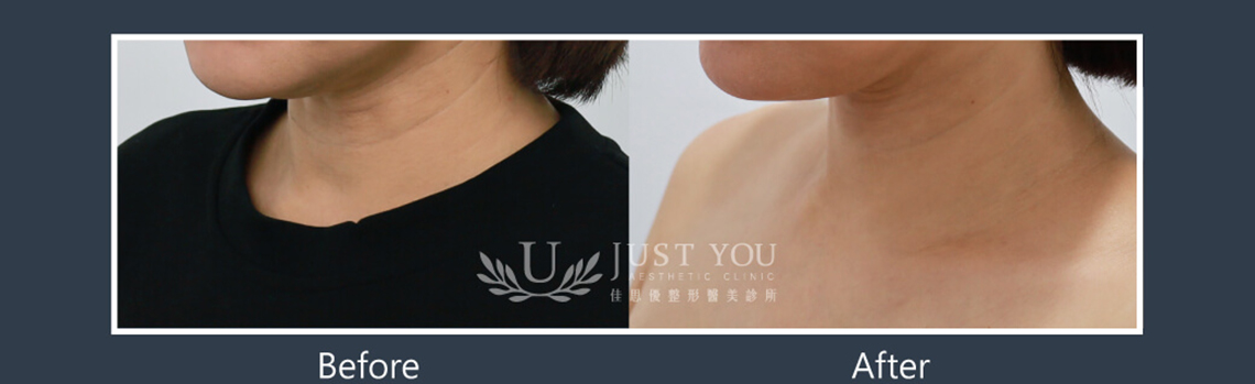Profhilo 逆時針《實際案例》-脖紋治療-案例2