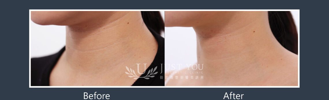 Profhilo 逆時針《實際案例》-脖紋治療-案例3
