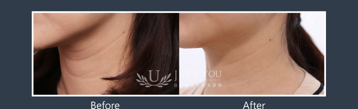 Profhilo 逆時針《實際案例》-脖紋治療-案例4