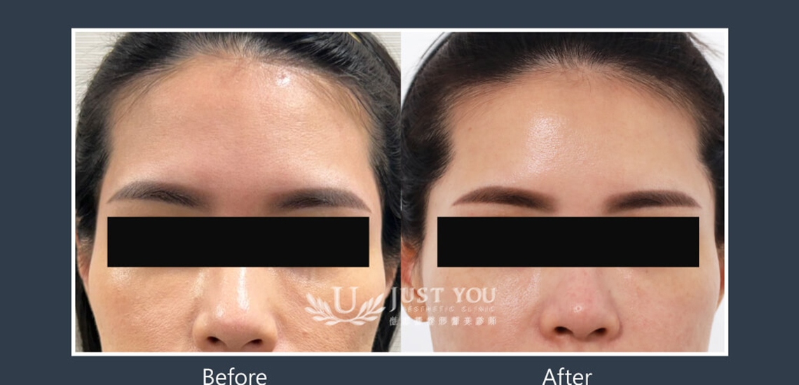 Profhilo 逆時針《實際案例》-額頭6-正面