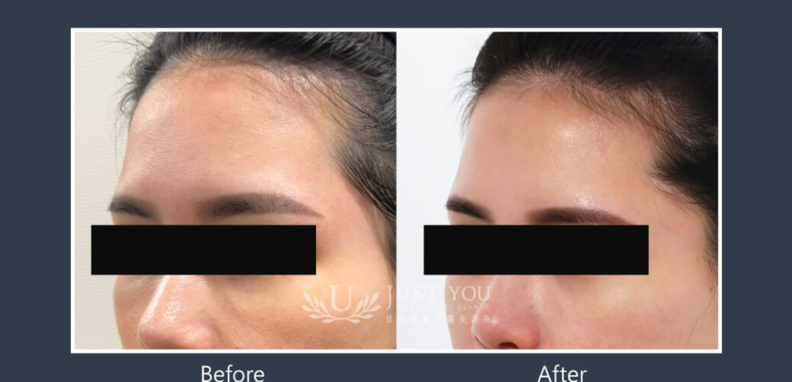 Profhilo 逆時針《實際案例》-額頭6-側面