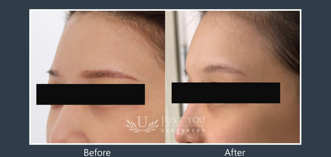 Profhilo 逆時針《實際案例》-額頭1-45度