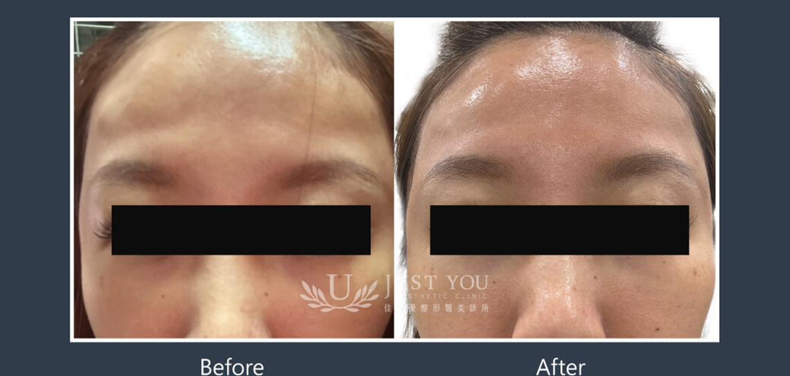 Profhilo 逆時針《實際案例》-額頭2-正面