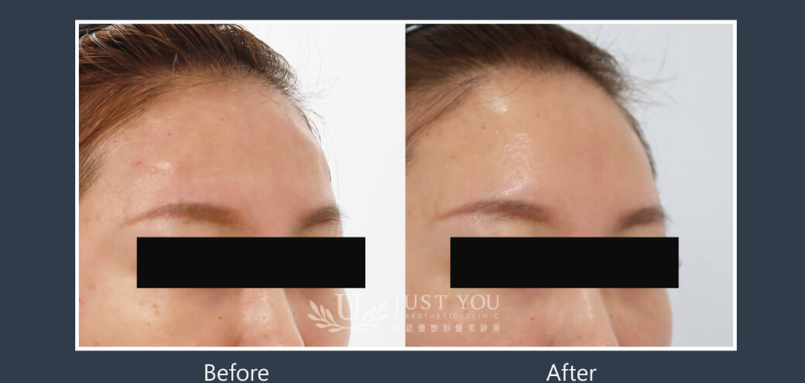 Profhilo 逆時針《實際案例》-額頭2-45度