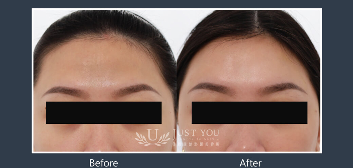 Profhilo 逆時針《實際案例》-額頭3-正面