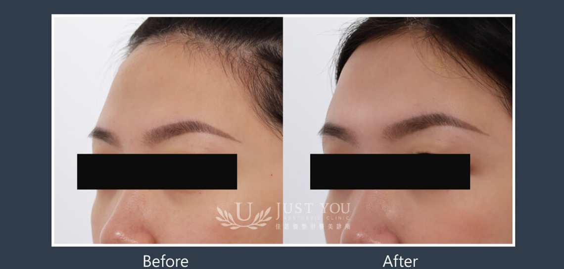 Profhilo 逆時針《實際案例》-額頭3-45度