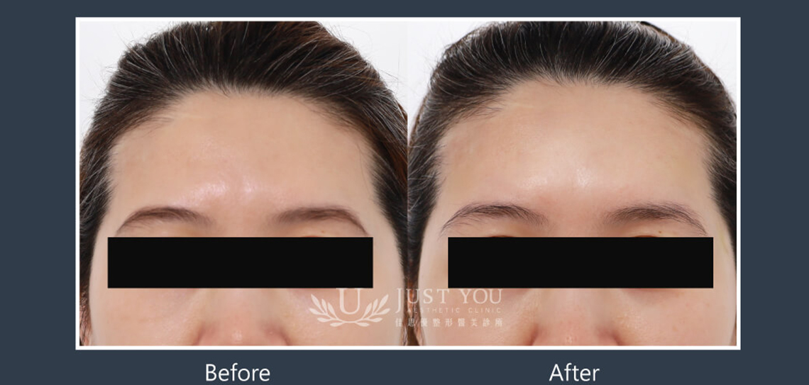 Profhilo 逆時針《實際案例》-額頭4-正面