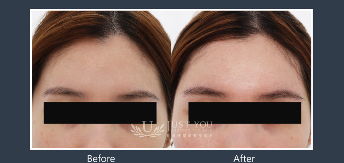 Profhilo 逆時針《實際案例》-額頭5-正面