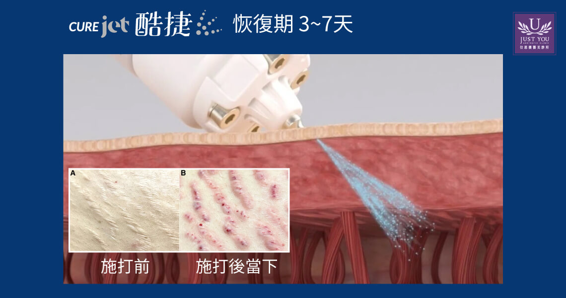 CUREJET 酷捷恢復期約7天