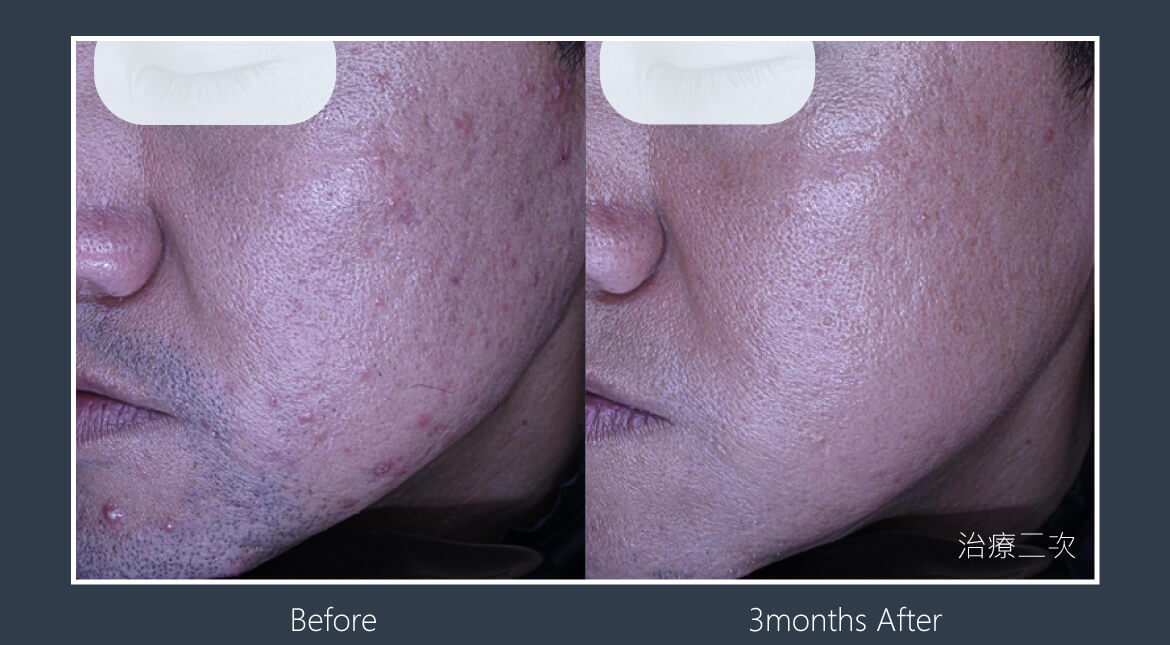 痘疤改善PDLLA 療程次數 : 3 次 療程間格 : 4 週