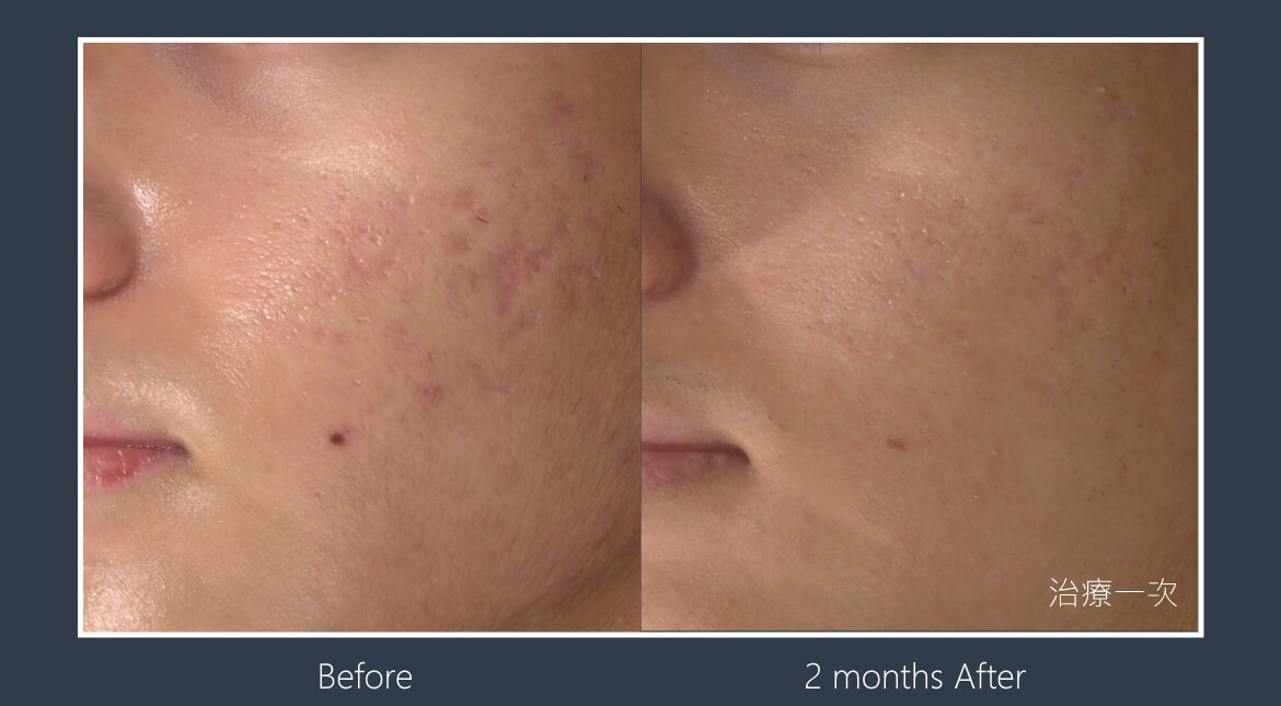 痘疤改善-男性