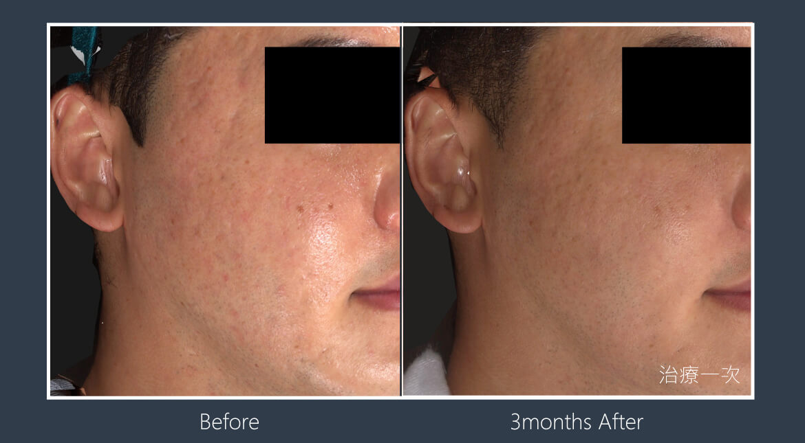 酷捷CUREJET《實際案例》痘疤改善/療程次數 : 1 次
