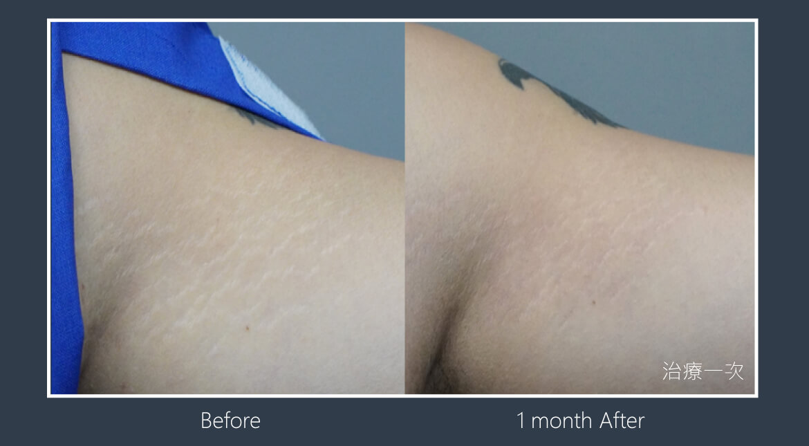 酷捷CUREJET《實際案例》生長紋1