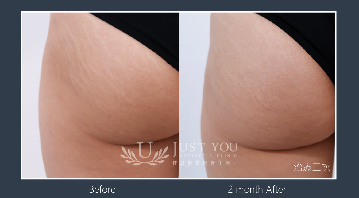 酷捷CUREJET《實際案例》生長紋2