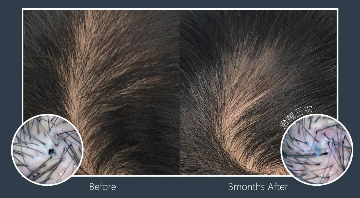 酷捷CUREJET《實際案例》1育髮