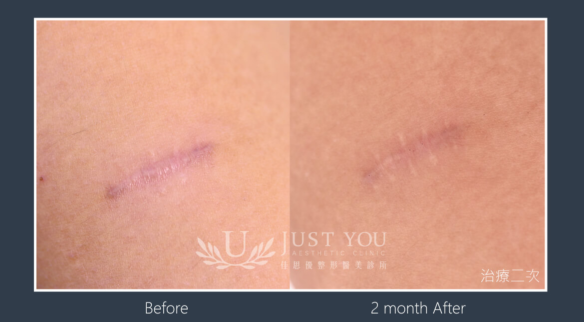 酷捷CUREJET《實際案例》手術痘疤改善/療程次數 : 2 次