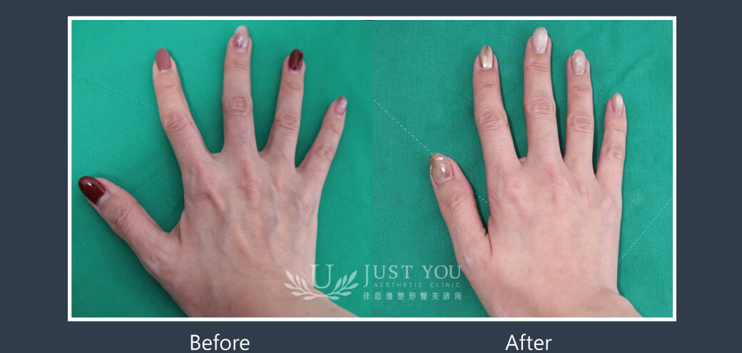 Doublyx EVO 彈力針《實際案例》-雞爪手雞爪手，改善手部細紋及皺紋