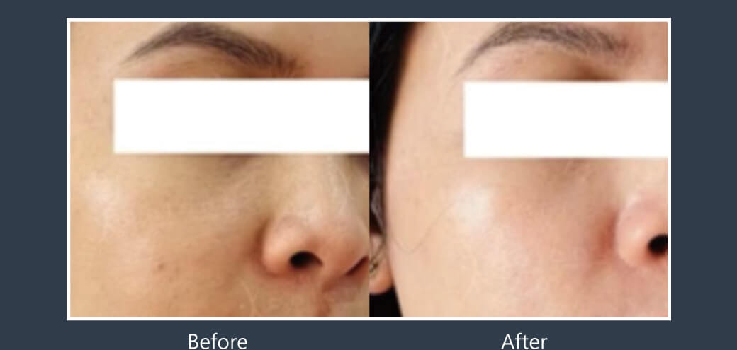 Doublyx EVO 彈力針《實際案例》-臉頰膚質改善