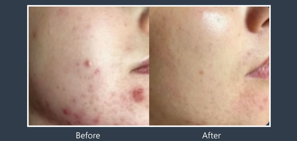 Doublyx EVO 彈力針《實際案例》-痘疤改善