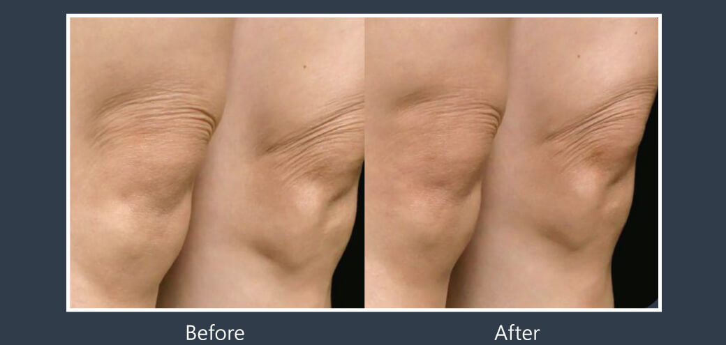 Doublyx EVO 彈力針《實際案例》-膝蓋紋路-1次治療後 (間隔一個月)路改善