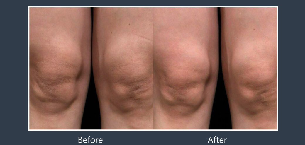 Doublyx EVO 彈力針《實際案例》-膝蓋紋路-一次治療後一個月對比