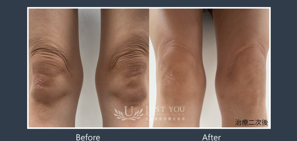 Doublyx EVO 彈力針《實際案例》-膝蓋紋路-2次治療後紋路改善