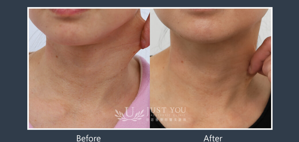 Doublyx EVO 彈力針《實際案例》-脖子紋路改善