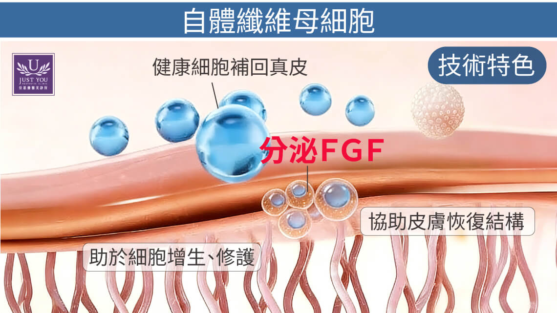 M Cell自体纤维母细胞治疗中，回补到真皮层的健康细胞会自然分泌FGF（纤维母细胞生长因子），这些因子有助于细胞增生、胶原蛋白生成与组织修复。