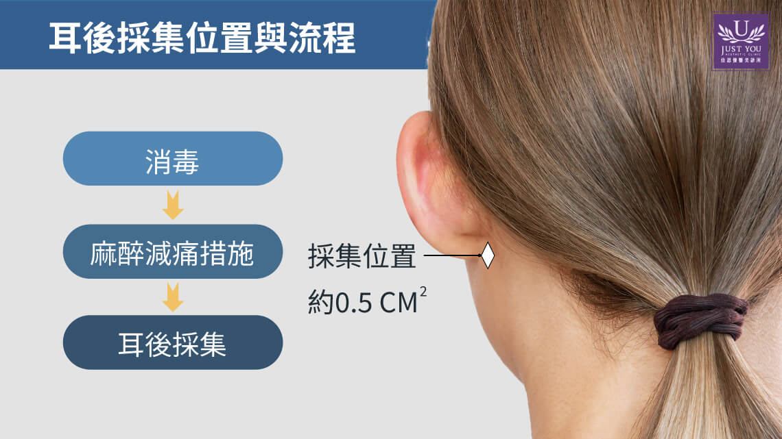 M Cell自体纤维母细胞耳后采集与注射时会使用相应的麻醉与止痛措施