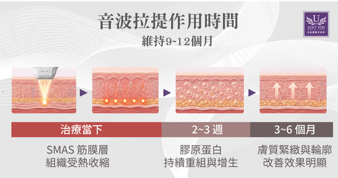 DUOTITE 多泰音波 单次疗程的良好状态可以维持9个月至一年左右