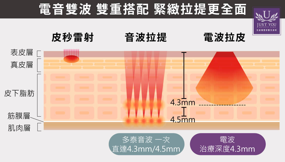 佳思优诊所量身规划出「第四代 Thermage FLX凤凰电波拉提」与「多泰音波拉提」交联式网状电音双波二合一治疗