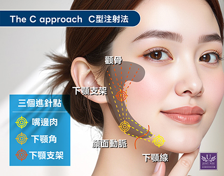 HArmonyCa™ 媄神針C-Shape注射打法:沿顴弓、下顎支架至下顎線的弧形路徑,透過下顎、下顎角與下顎支架三個進針點進行注射,適合針對下半臉鬆弛與輪廓線模糊進行基礎改善,建議基本用量為 2.5 ml。