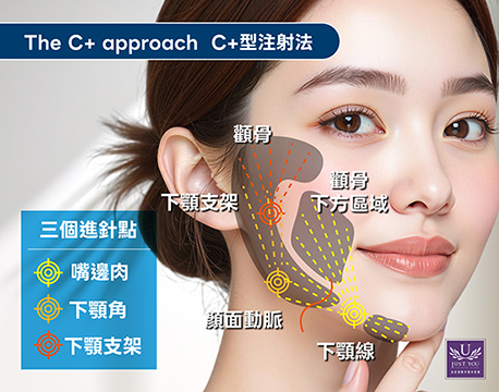 HArmonyCa™ 媄神針C+Shape注射打法:在 C-Shape 的基礎上,進一步延伸至下顎前溝與頰下區域,覆蓋範圍更廣,適合輪廓流失較明顯、同時希望改善嘴邊肉與中臉飽滿度的情況。