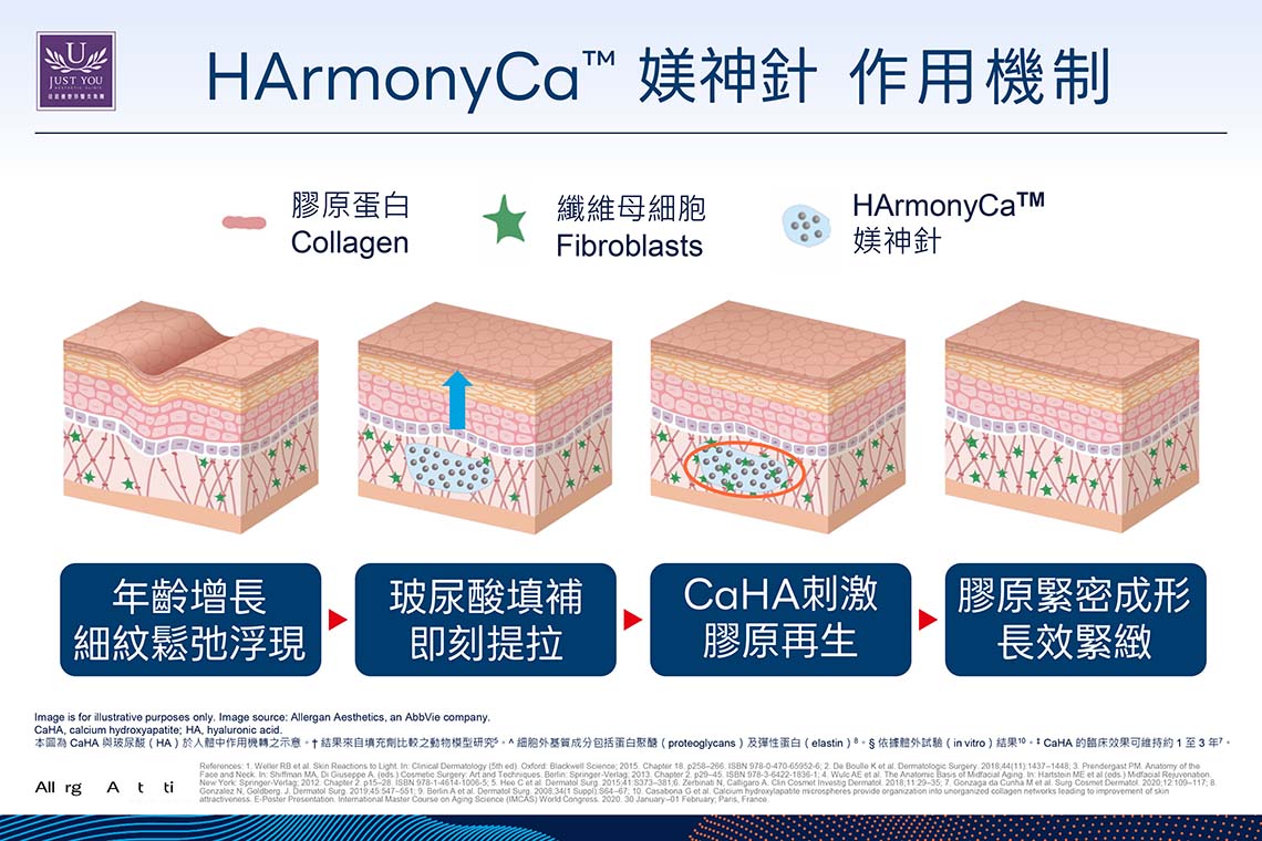 HArmonyCa™ 媄神針裡的玻尿酸支撐效果通常在注射後即可感受到輪廓的變化,下顎線、側臉輪廓與局部飽滿度都會有所提升。CaHA 刺激的膠原蛋白再生則屬於漸進式改善。