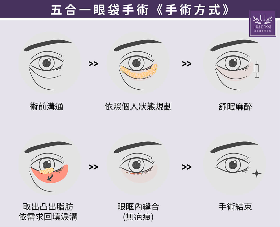 五合一无痕眼袋手术与传统眼袋手术的不同
